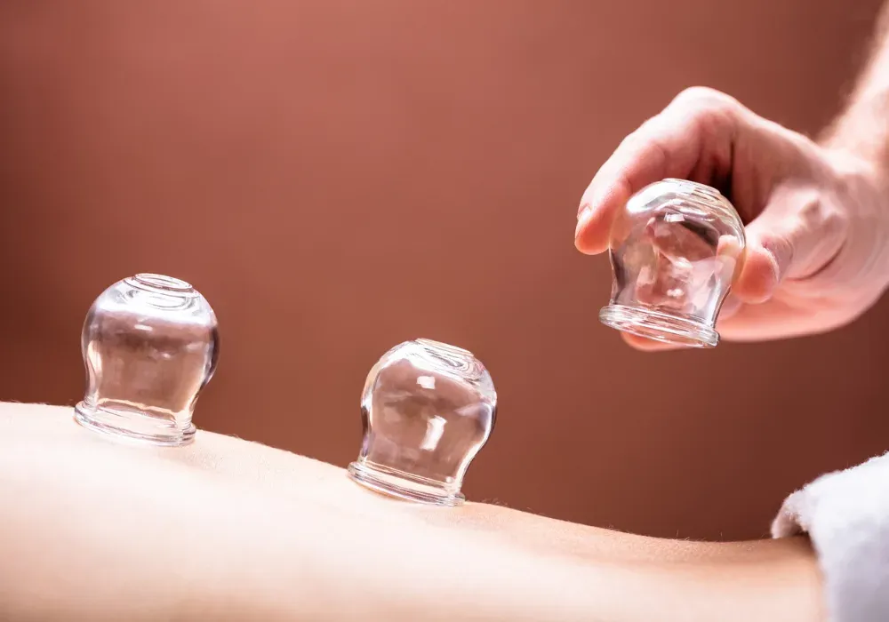 Cupping Therapy at Physio Melbourne